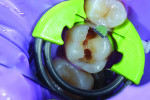 (5.) Occlusal view following placement of the sectional matrix system.