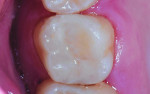 (12.) Posttreatment close-up occlusal view of the completed final restoration.