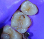 (1.) Preoperative close-up occlusal view of tooth No. 14 exhibiting a failing occlusal composite restoration.