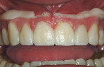 Figure 15  After removing the tray, excess is peeled away and the temporary is then trimmed and polished for results that elicit patient satisfaction.