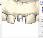 A digitally-designed ATLANTIS Abutment.