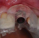 The SIMPLANT Guide with index marking is used to ensure correct rotational alignment of implant.