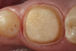 Figure 2  Impression taking requires recording the exact dimensions of the preparation, the position of the soft tissue, the architecture of the margins of the preparation, and the relationship of the prepared teeth to the surrounding dentition.