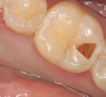 Figure 4  Final removal of caries-infected dentin was achieved using a No. 6 K1SM bur at 1,250 rpm.