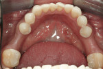 Figure 4  The edentulous site.