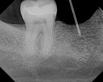 Figure 7  Radiographic depiction of entry of anesthetic device into the medullar space.