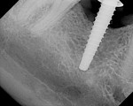 Figure 14  The #3 osteotome fully seated.