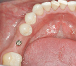 Figure 23  The implant 6 weeks post-placement, note bulk-out of the previously resorbed ridge.