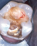 Figure 3  Pulp exposure followed by calcium hydroxide placement and final excavation.