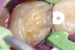 Figure 8  Fluoride-releasing flowable along the cervical margin area with RMGI liner in the deepest areas of the pulpal floor.