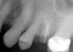 Figure 12  The highlighted area illustrates the gain in available bone after internal sinus augmentation and implant placement.