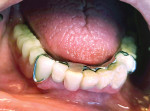 Fig 12. A new cast partial denture,
fabricated from an impression taken at the initial appointment, was inserted to complete treatment (Lasermet partial denture, Trident Dental Laboratories, tridentlab.com). Treatment was completed in two visits, including the initial appointment, which helped accommodate the patient’s dementia issues. The patient has been placed on 3-month recall prophy related to his inability to adequately perform homecare and will be monitored and modified as needed.