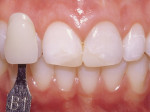 Figure 4  Visual assessment using classic Vita shade tabs showed the patient's dentin shade to be B1.