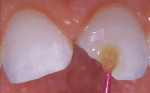 Figure 7  A single-component, self-etching bonding agent was brushed onto the preparations for 10 seconds.